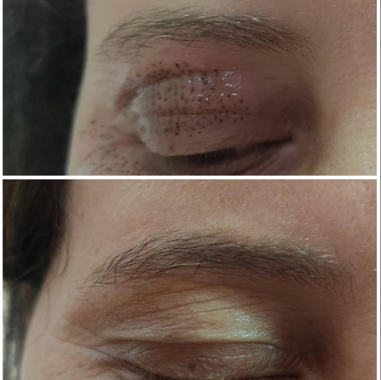 Avant Plasma Pen Rabat