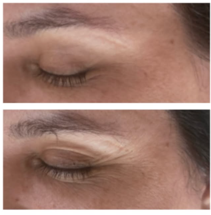 Après Plasma Pen Rabat lifting