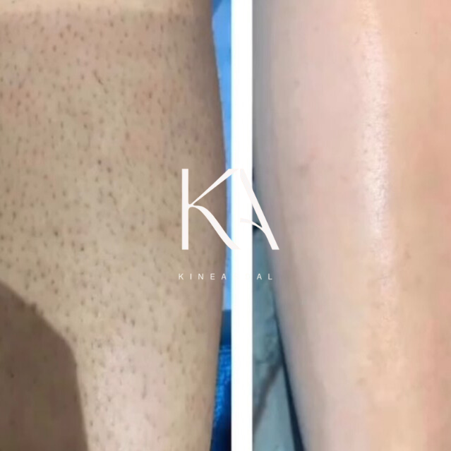 Résultat épilation laser jambes Rabat