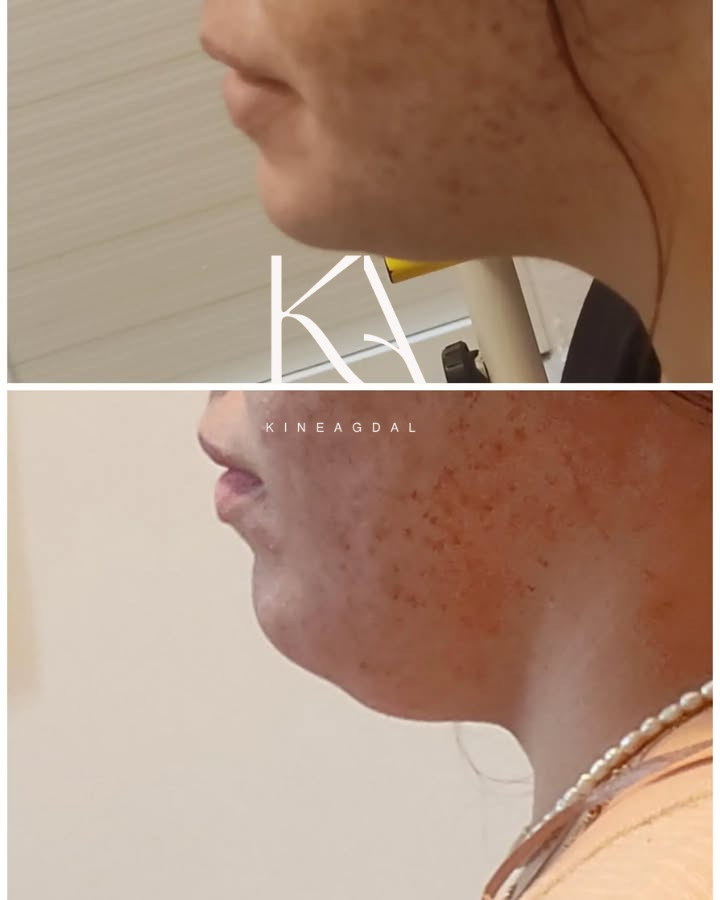 Visage avant traitement HIFU