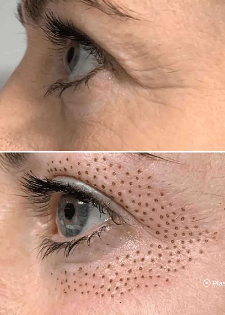 Après Plasma Pen Rabat lifting