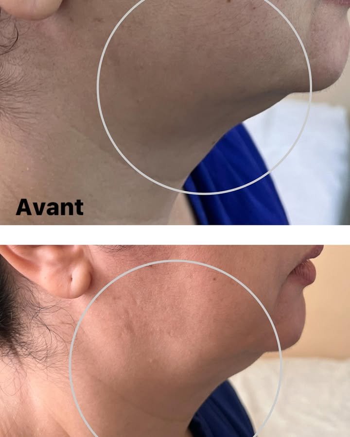 Résultat après séances HIFU 15D