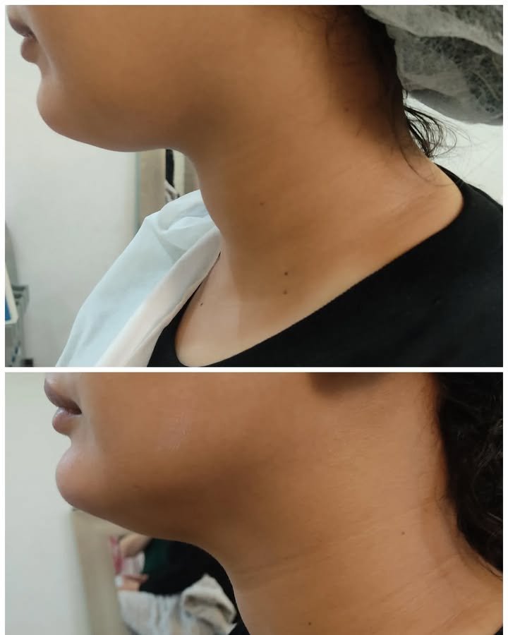 Résultat après séances HIFU 15D