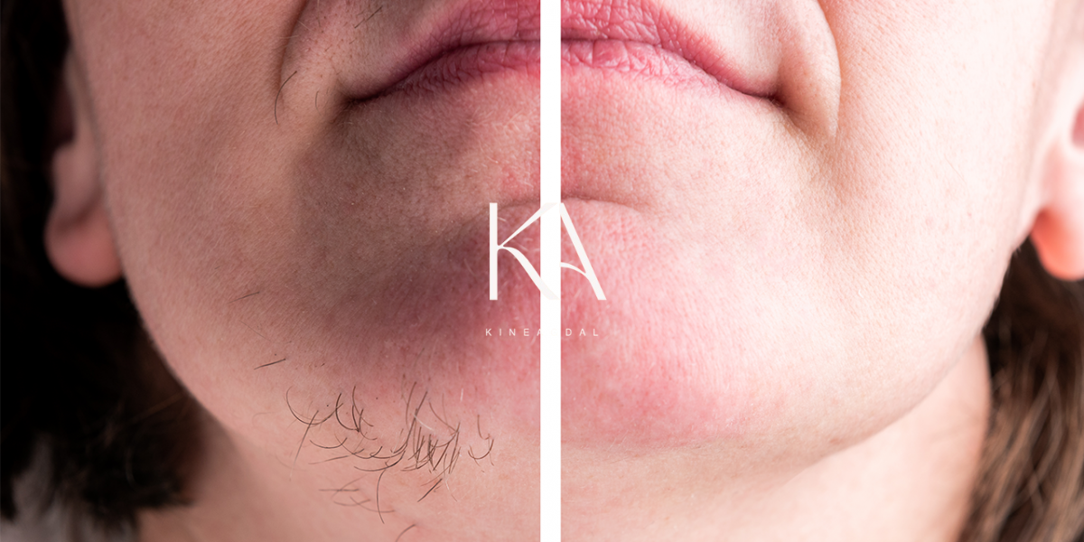 Épilation laser visage femme Rabat résultat